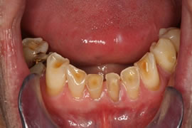 CEREC AC OMNICAM ПРОСТОЕ СКАНИРОВАНИЕ БЕЗ АНТИБЛИКОВОГО СПРЕЯ 28.jpg