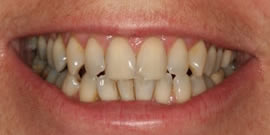 CEREC AC OMNICAM ПРОСТОЕ СКАНИРОВАНИЕ БЕЗ АНТИБЛИКОВОГО СПРЕЯ 22.jpg