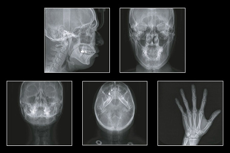 GENORAY Papaya 3D 23x24 - компьютерный томограф с цефалостатом