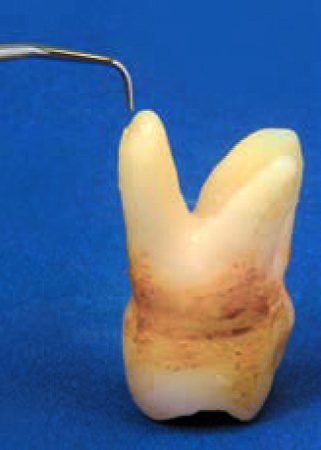 Acteon P15RD – Насадка с алмазным покрытием