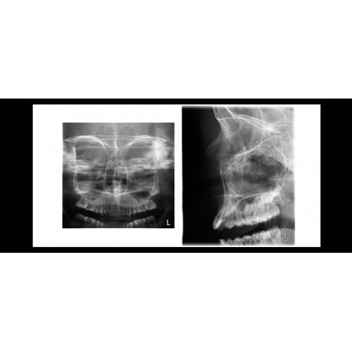 Planmeca ProOne - универсальный цифровой ортопантомограф