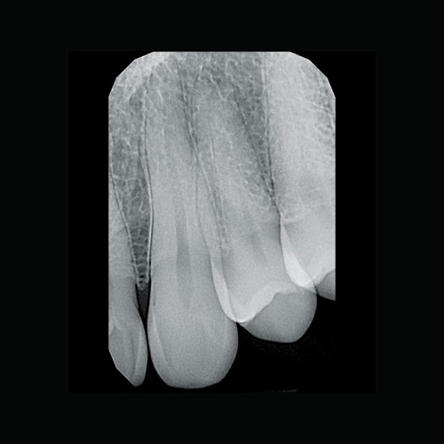 KaVo Gendex GXS-700 - система компьютерной радиовизиографии (сенсор №1)