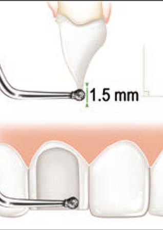 Acteon PMV1 – Насадка шарик с алмазным покрытием