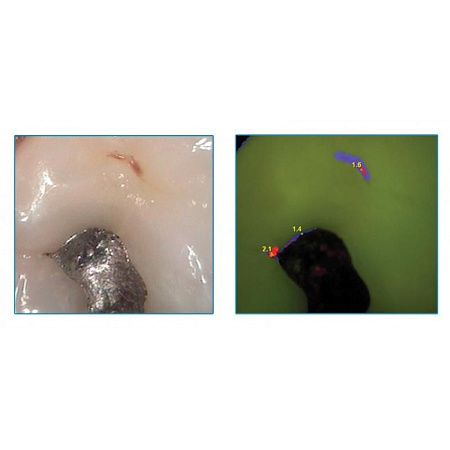 Air Techniques Spectra - оптический детектор кариеса 