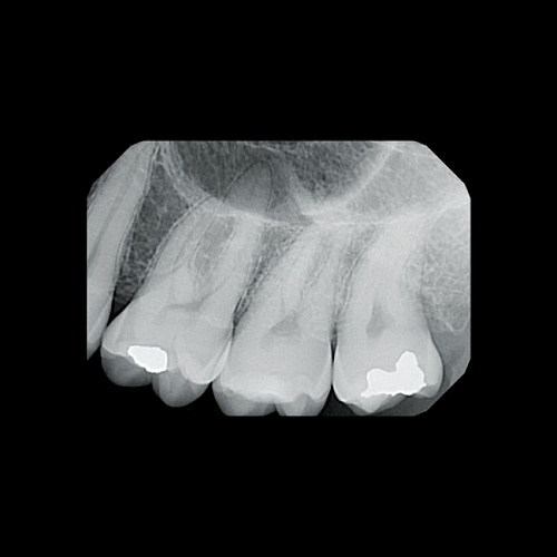 KaVo Gendex GXS-700 - система компьютерной радиовизиографии (сенсор №1)